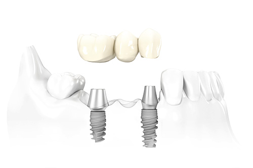 Why Dental Implants